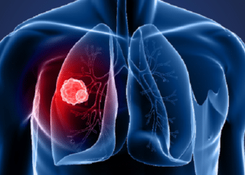 Signs of Lung Cancer